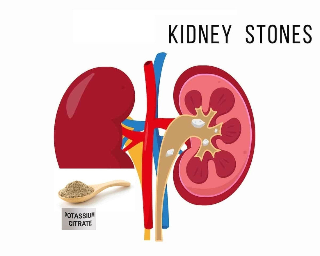 Potassium Citrate for Uric Acid Stones