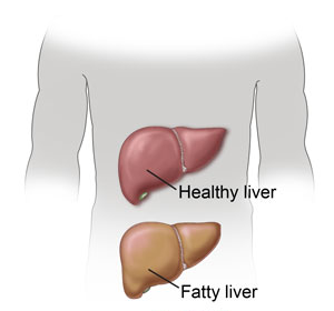 Top Supplements For Fatty Liver